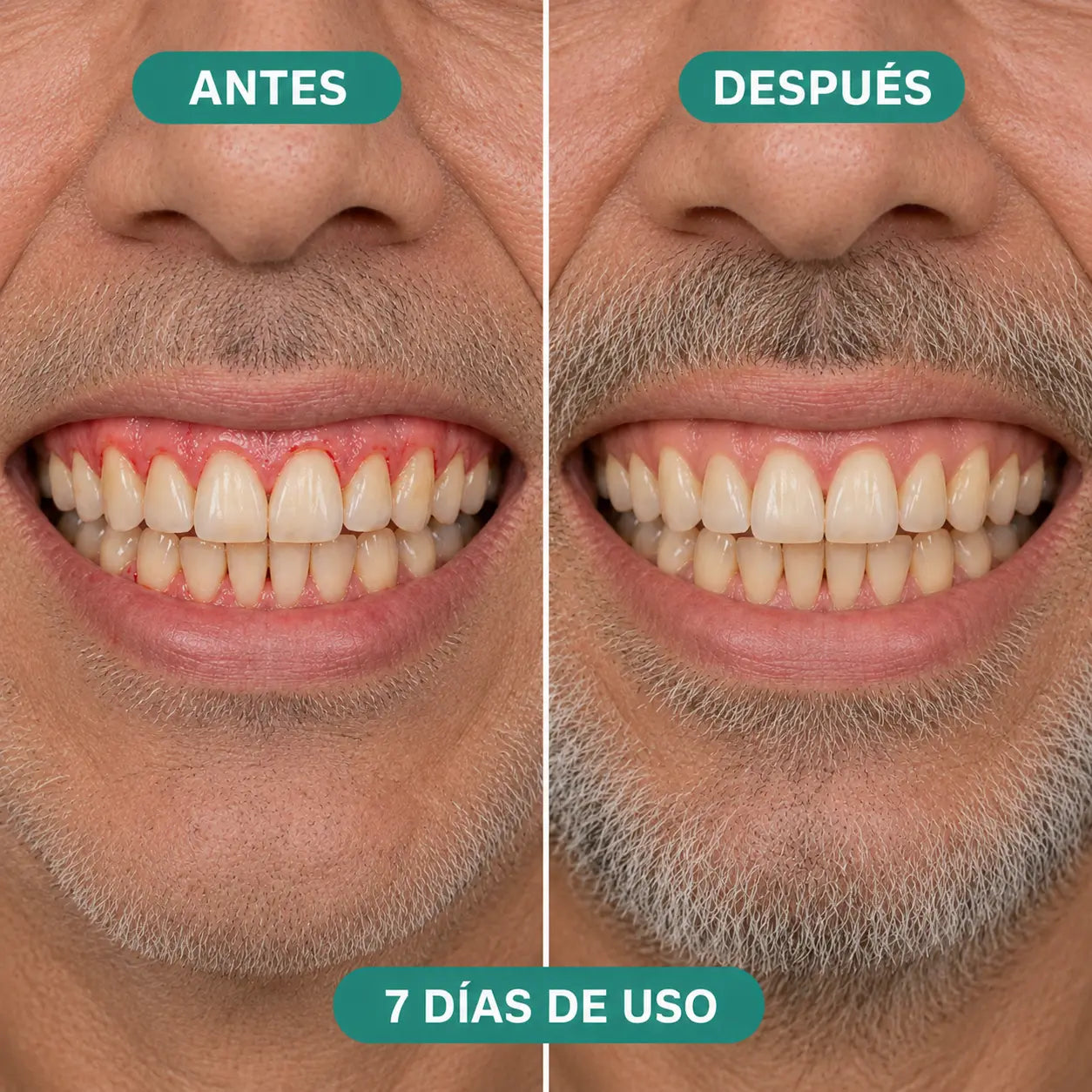 Antes y después de 7 días de uso del irrigador Velora - hombre mayor
