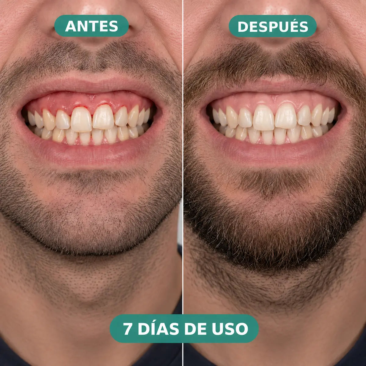 Antes y después de 7 días de uso del irrigador Velora - hombre