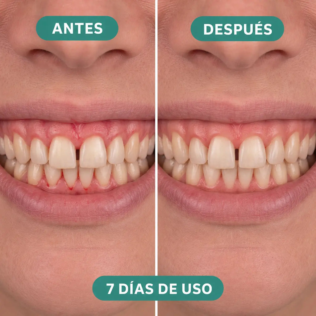 Antes y después de 7 días de uso del irrigador Velora - mujer