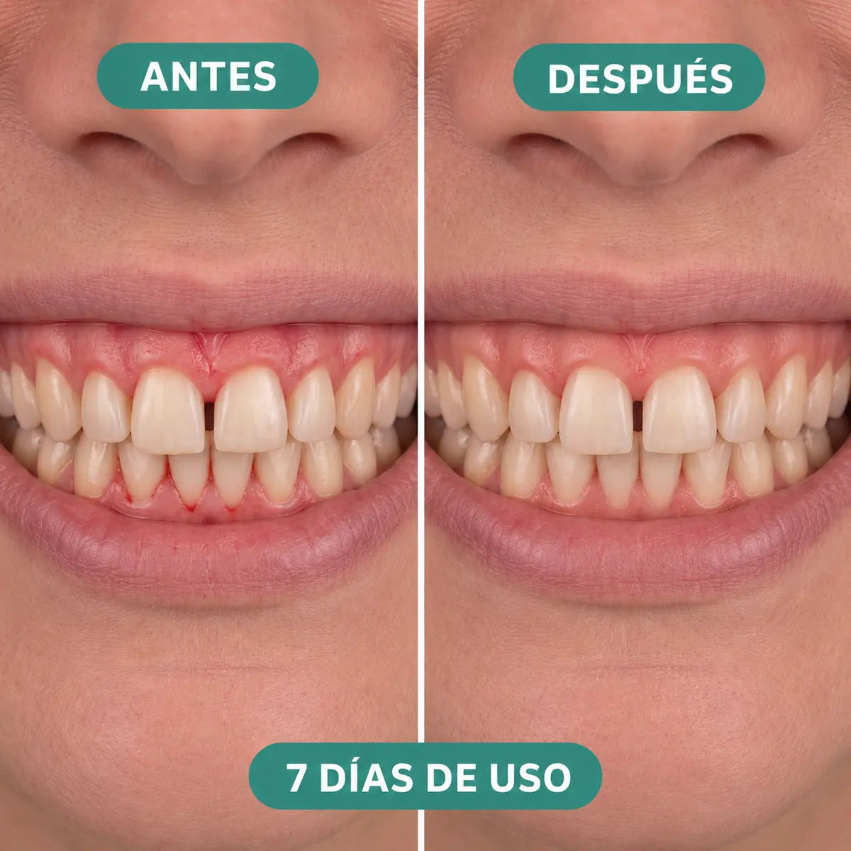 Antes y después de 7 días de uso del irrigador Velora - mujer